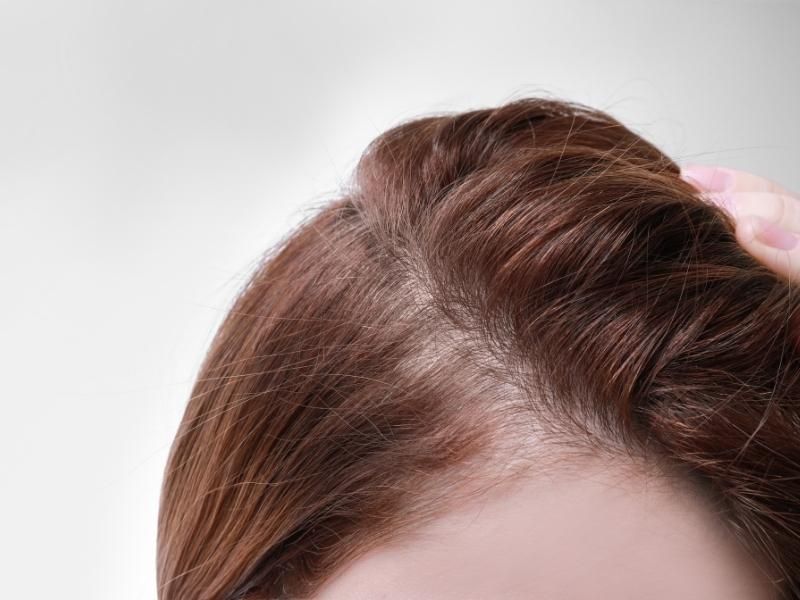 Rụng tóc từng mảng có thể vì nhiều nguyên nhân chứ không chỉ do covid