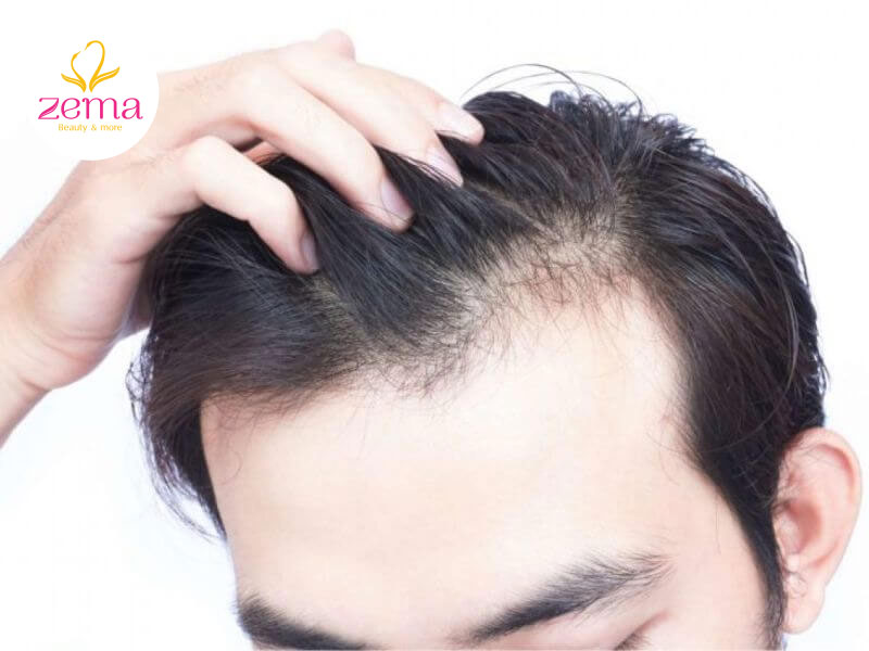 Rụng tóc do di truyền